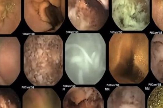 Lời cảnh báo gây sốc dành cho những "tín đồ" của mì ăn liền