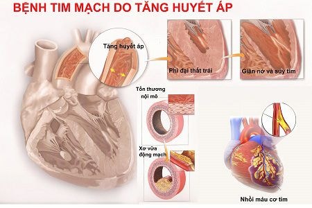 Đột quỵ não không chỉ do tăng huyết áp