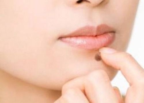 Những cách tẩy nốt ruồi đơn giản tại nhà