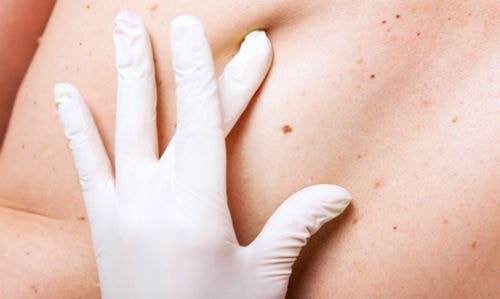 Nốt ruồi cảnh báo ung thư