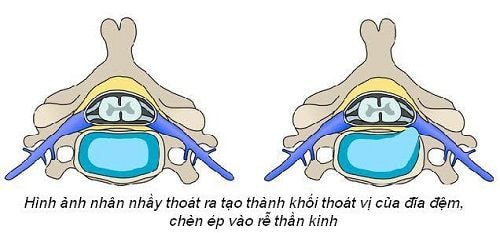 Dấu hiệu đau thần kinh tọa hay thoát vị đĩa đệm