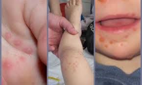 Cảnh báo về các triệu chứng dẫn đến bệnh tay chân miệng