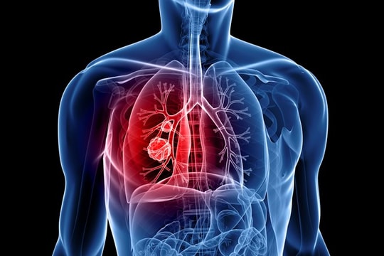 Các nhà khoa học Bỉ có thể phát hiện ung thư phổi bằng thử máu