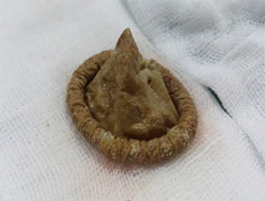 Mổ lấy sỏi bàng quang bất ngờ phát hiện bao cao su