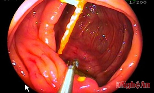 Ung thư đại - trực tràng và những sai lầm cần tránh