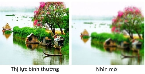 3 kiểu nhìn mờ cảnh báo nguy cơ mù lòa