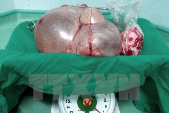 Cắt bỏ thành công khối u xơ tử cung khổng lồ nặng 7,8kg