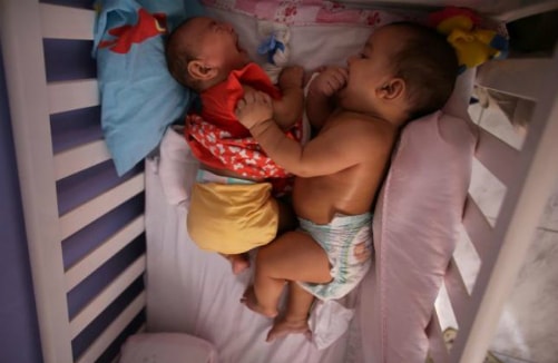 Hai trẻ song sinh chỉ có một bé đầu nhỏ do nhiễm Zika