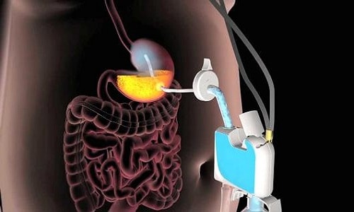 Thiết bị giảm cân bằng cách hút thức ăn trong dạ dày