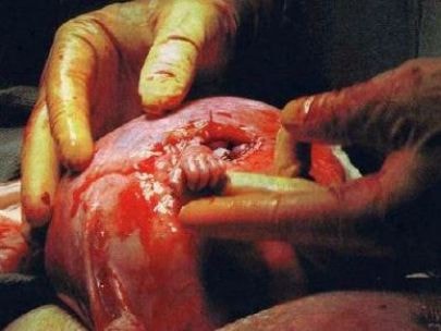 Thai nhi nắm tay bác sĩ mổ làm rung động thế giới giờ ra sao?