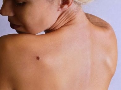 Nốt ruồi cảnh báo bệnh tật