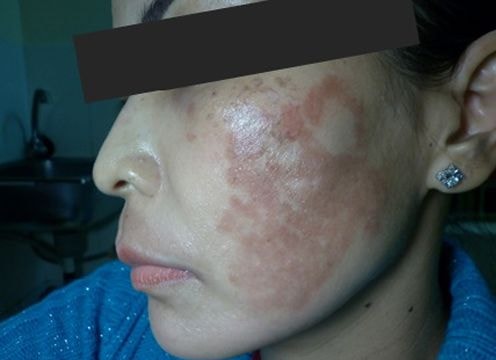 Kem tẩy trắng tàn phá làn da như thế nào