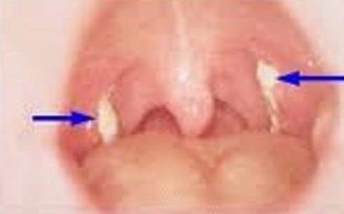 Những biến chứng chết người khi bị bệnh bạch hầu