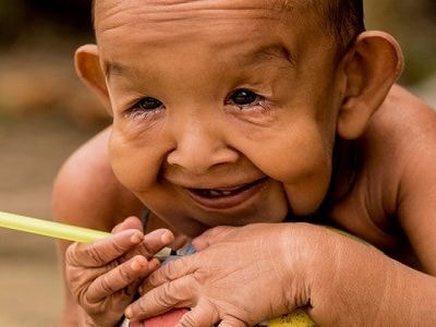 Cậu bé 4 tuổi có hình hài như ông lão 80