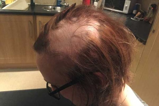 Áp lực thi cử khiến thiếu nữ trụi hết tóc