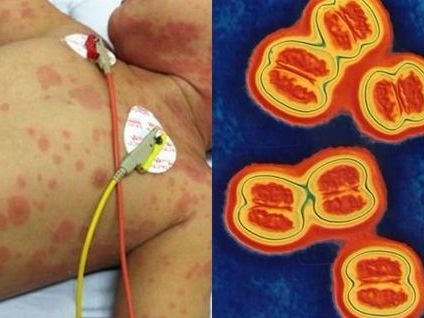 [Infographic] Tìm hiểu bệnh viêm não mô cầu