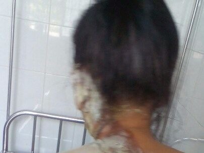 Công an triệu tập người chồng rót nước sôi vào lỗ tai vợ