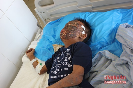 Ngã vào bếp củi, cháu bé người Khơ mú bị bỏng toàn mặt