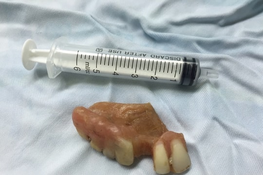 Gắp nội soi lấy hàm răng giả từ thực quản