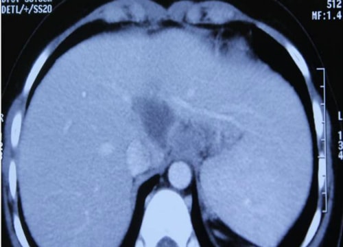 Cô gái Việt trở thành ca bệnh lao gan hiếm thứ 2 thế giới