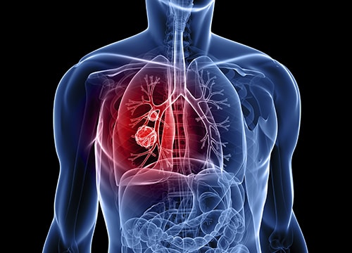 [Infographics] Hãy bảo vệ bạn khỏi bệnh ung thư phổi