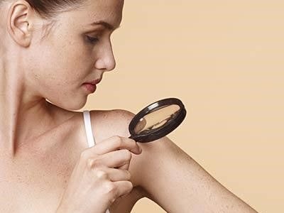 Tự kiểm tra ung thư da trong 5 phút