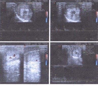 Bé 8 tuổi đứt dương vật do kẹt vào khe ván