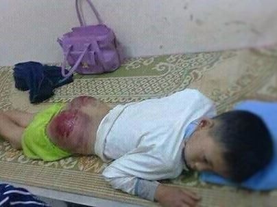 Bé 13 tuổi bị bố đánh bầm mông phải nhập viện