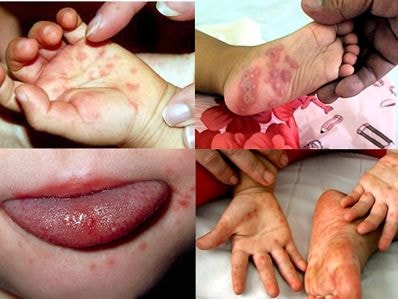 Bộ Y tế khuyến cáo phòng bệnh tay chân miệng