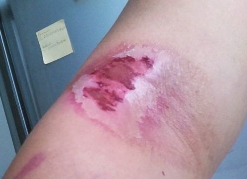 Cách phân biệt vết zona thần kinh, 'giời leo' và kiến 3 khoang gây tổn thương