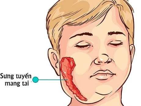 Nhận biết và xử lý khi mắc quai bị