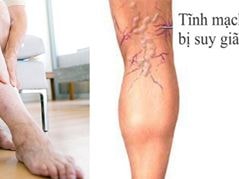 10 lời khuyên dành cho người bị suy tĩnh mạch