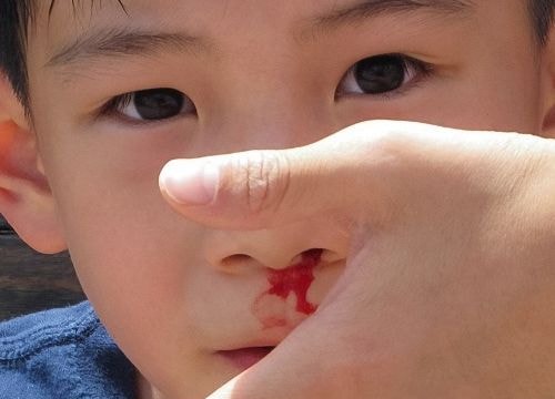 Chảy máu cam - dấu hiệu ung thư máu
