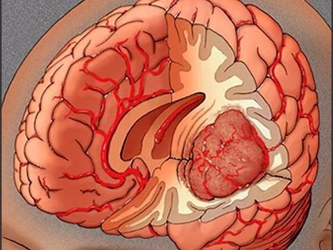 Những dấu hiệu cho thấy bạn có thể bị u não