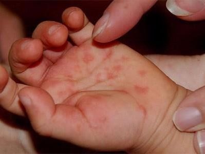 Triệu chứng và cách điều trị khi trẻ bị tay chân miệng