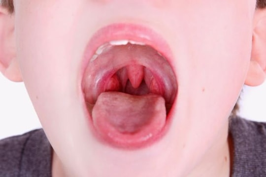 Liên cầu khuẩn tan huyết nhóm A thường gây viêm họng