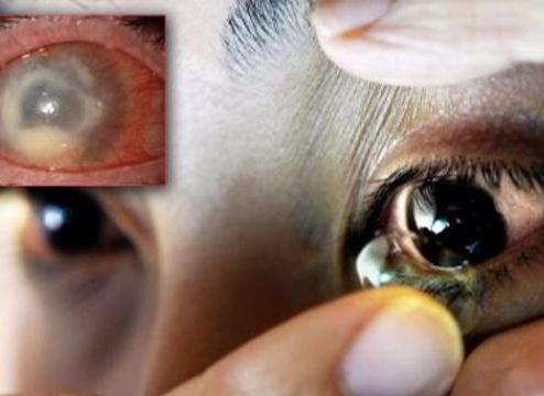 Nguy cơ mù vĩnh viễn vì đeo kính áp tròng làm đẹp