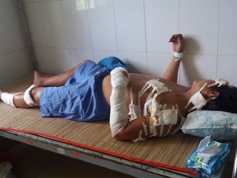 Ghen tuông, vợ cầm dao chém chồng gần 20 nhát