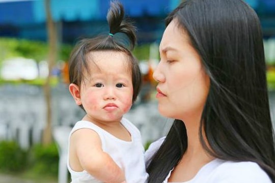 Lưu ý cách chăm sóc trẻ khi thủy đậu vào mùa