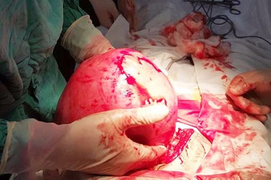 Bóc khối u xơ khổng lồ nặng tới 3,51 kg