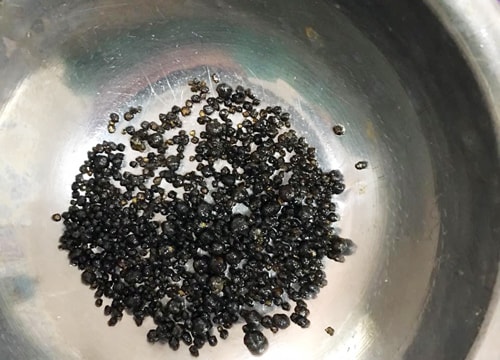 Nghệ An: Gần 1.000 viên sỏi nằm trong túi mật nữ bệnh nhân