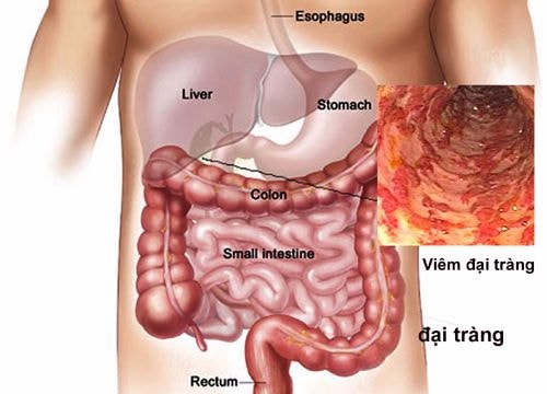 5 dấu hiệu giúp tự nhận biết sớm ung thư đại trực tràng