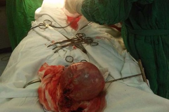 Nghệ An: Bóc thành công khối u xơ gần 2kg
