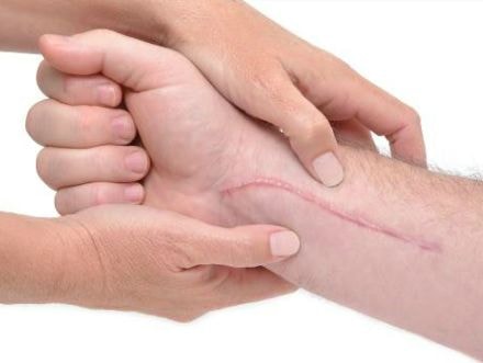 Ba cách giúp bạn đẩy lùi sẹo