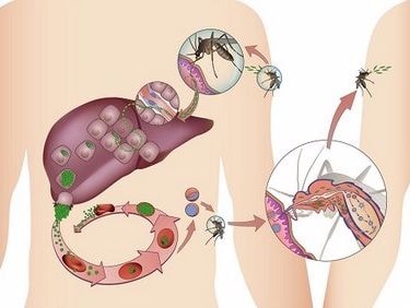Cách phân biệt nhanh 'sốt xuất huyết' và 'sốt rét' để điều trị đúng