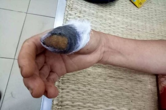 Chỉ vì nắm lá mồng tơi, một phụ nữ bị cắn đứt ngón tay cái