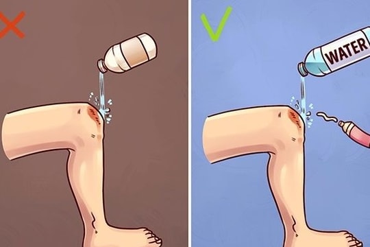Mẹo sơ cứu đơn giản nhưng 90% người làm sai khi khẩn cấp