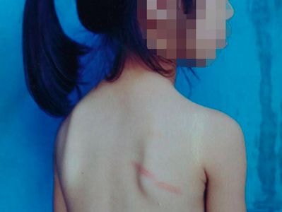 Phụ huynh 'tố' cô giáo đánh con mình thâm tím người