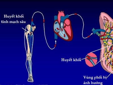 Thuyên tắc phổi suýt chết vì ôm máy tính hơn 12 giờ/ngày