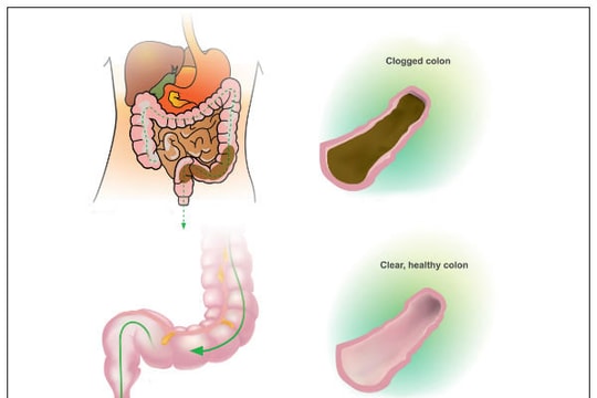 Cách nào giảm nguy cơ ung thư đại trực tràng?